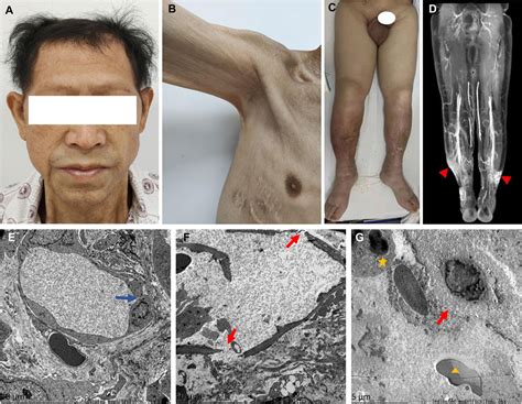 kapillarlecksyndrom symptome|Orphanet: Systemic capillary leak syndrome